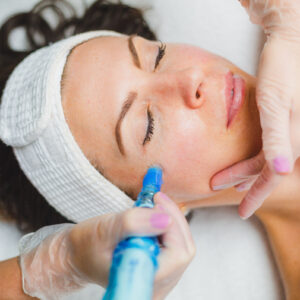 Microneedling