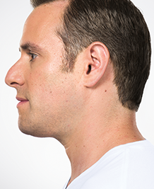 Kybella Treatment After on Male