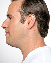 Kybella Treatment Before on Male