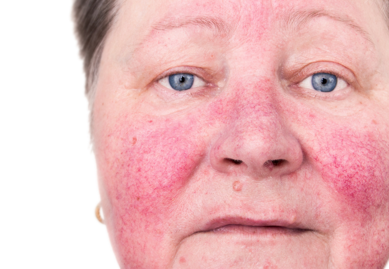 example of skin redness on the face called Rosacea