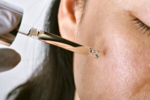 woman receiving an acne facial in Kansas City