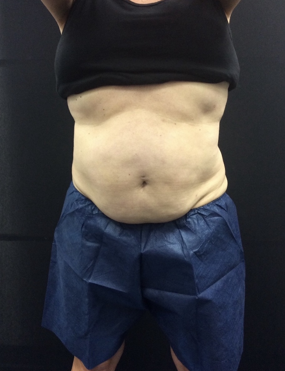 Coolsculpting treatment before photo