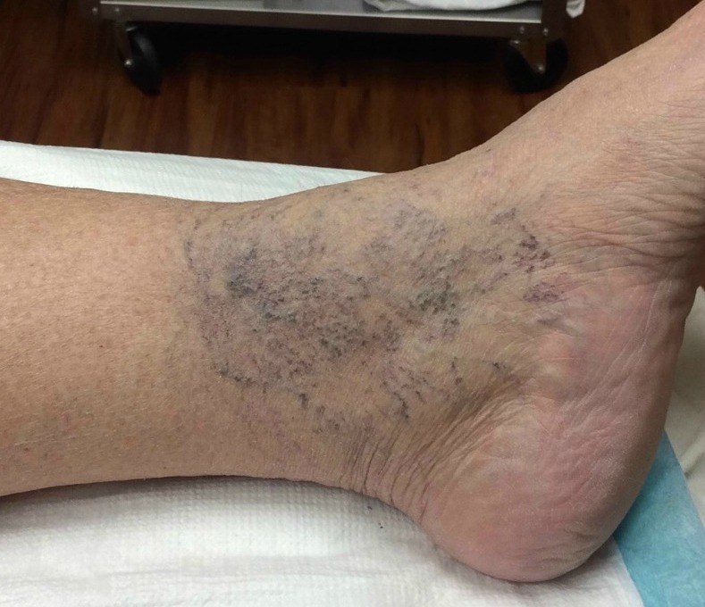 spider vein treatment from aestheticare - what is a spider vein?
