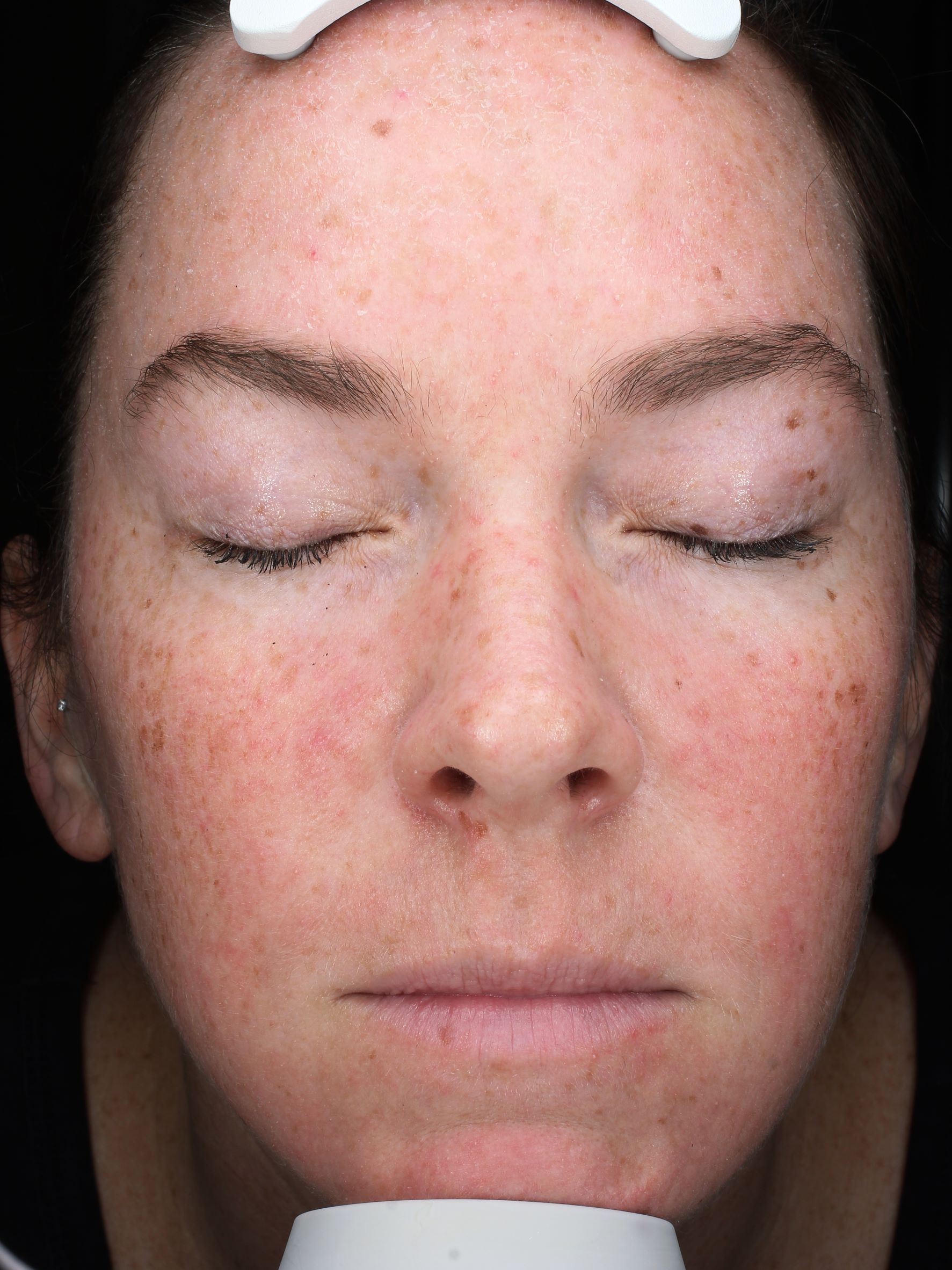 face skin laser treatment before