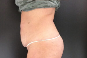 Coolsculpting - After