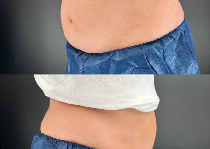 coolsculpting results