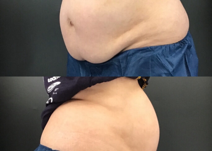 coolsculpting treatment before