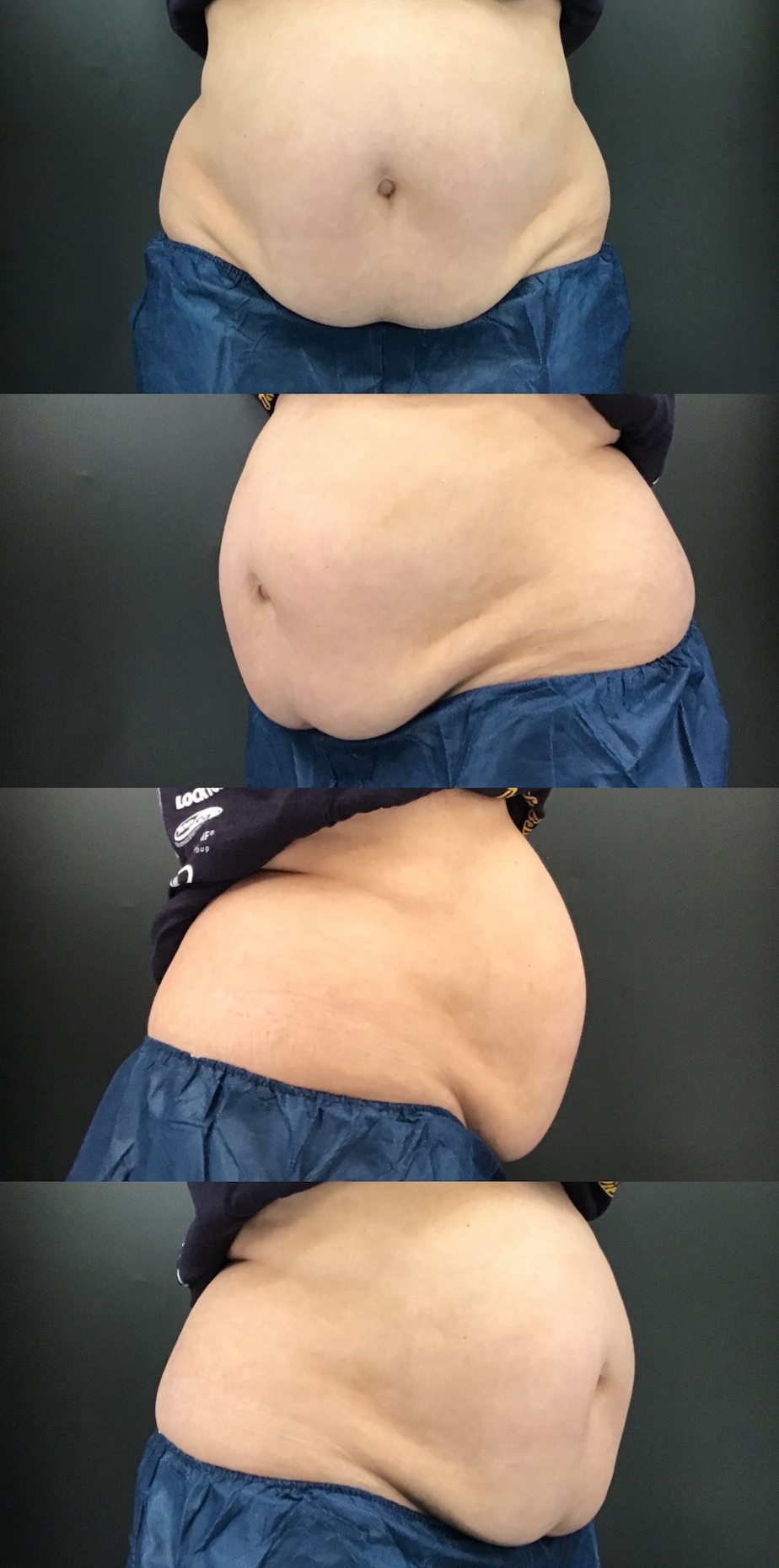 coolsculpting treatment before