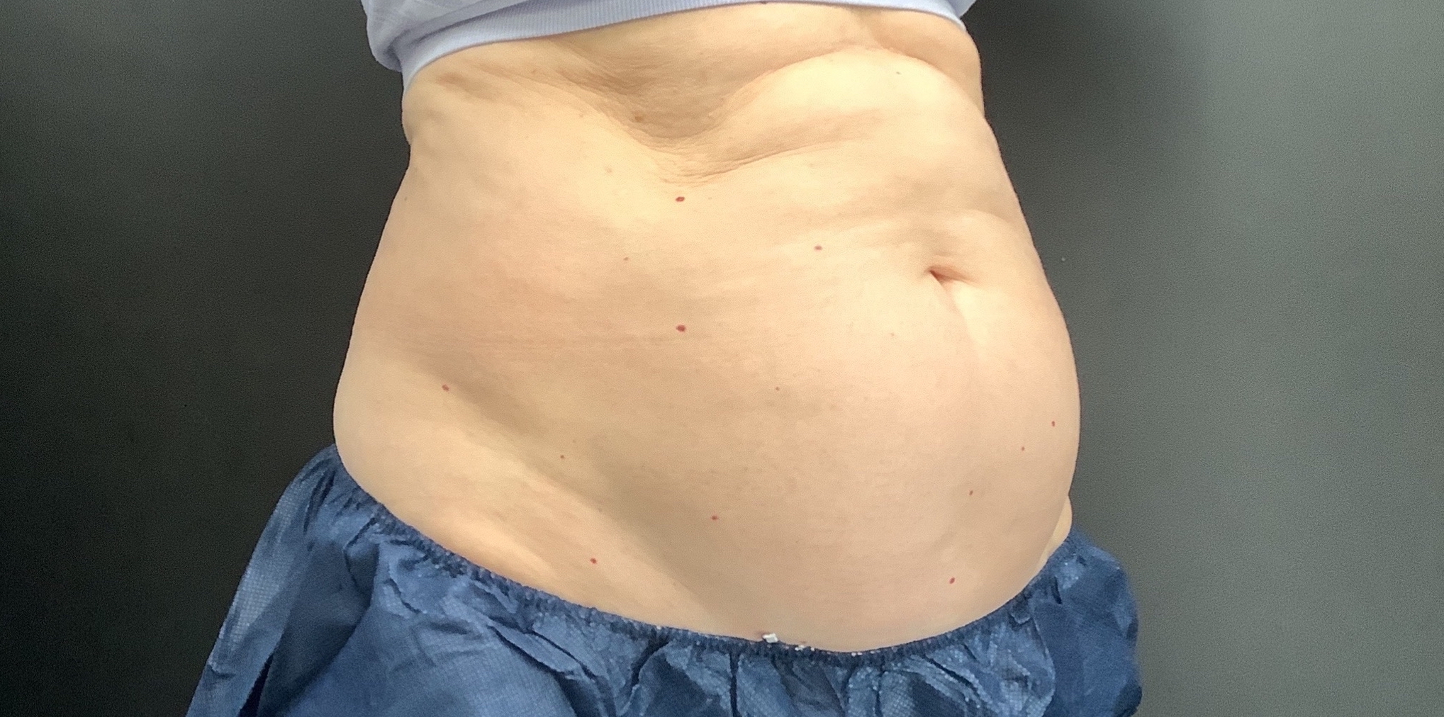 coolsculpting treatment before abdomen