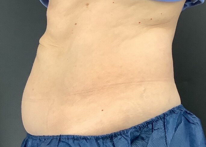 side profile of coolsculpting treatment results
