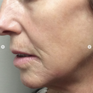 facial treatment dermal fillers before