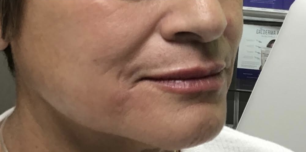 Dermal-Fillers_AfterFiller-Before-and-After