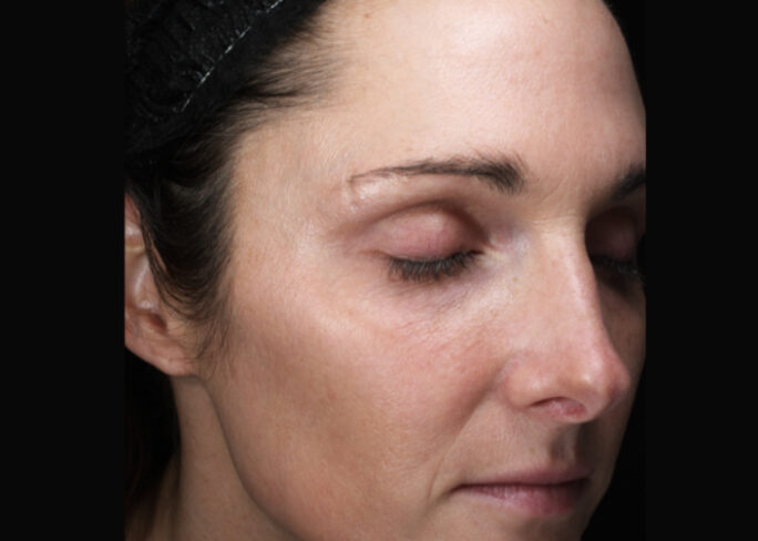 skin facial moxi laser treatment results