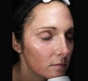 moxi laser treatment face before