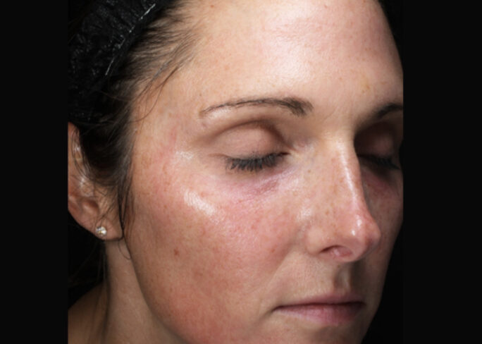 moxi laser treatment face before