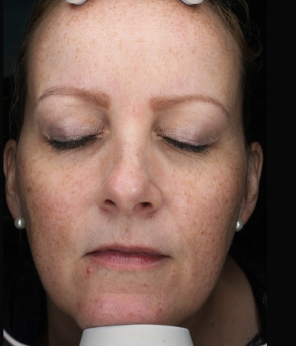 skin facial treatment moxi before