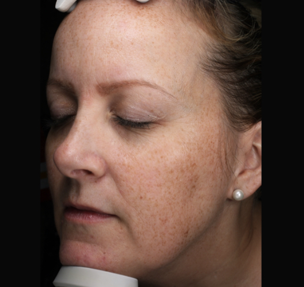 skin facial treatment moxi laser before
