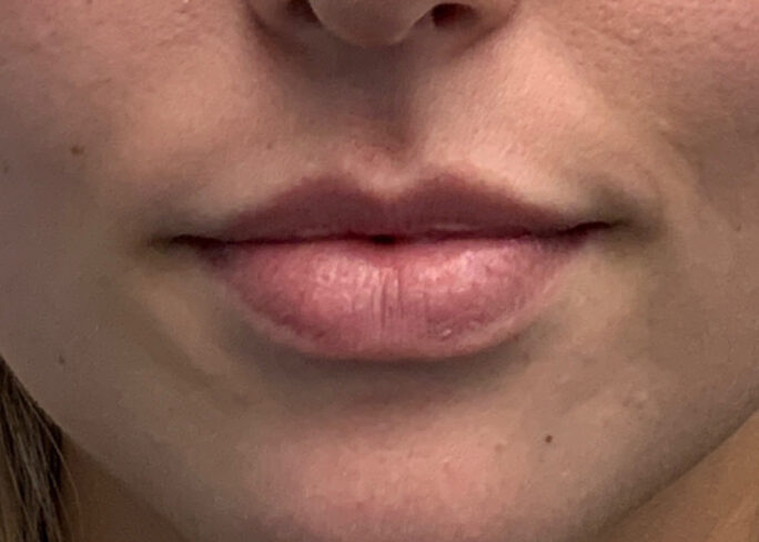 Permanent Lip Color - Before