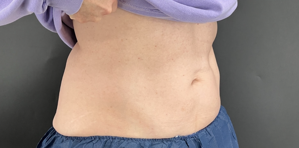 Best CoolSculpting Cost in Upper Marlboro Archives - Visage Dermatology and  Aesthetic Center